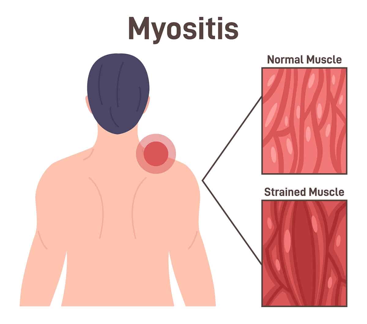 Myositis Symptoms In Marathi