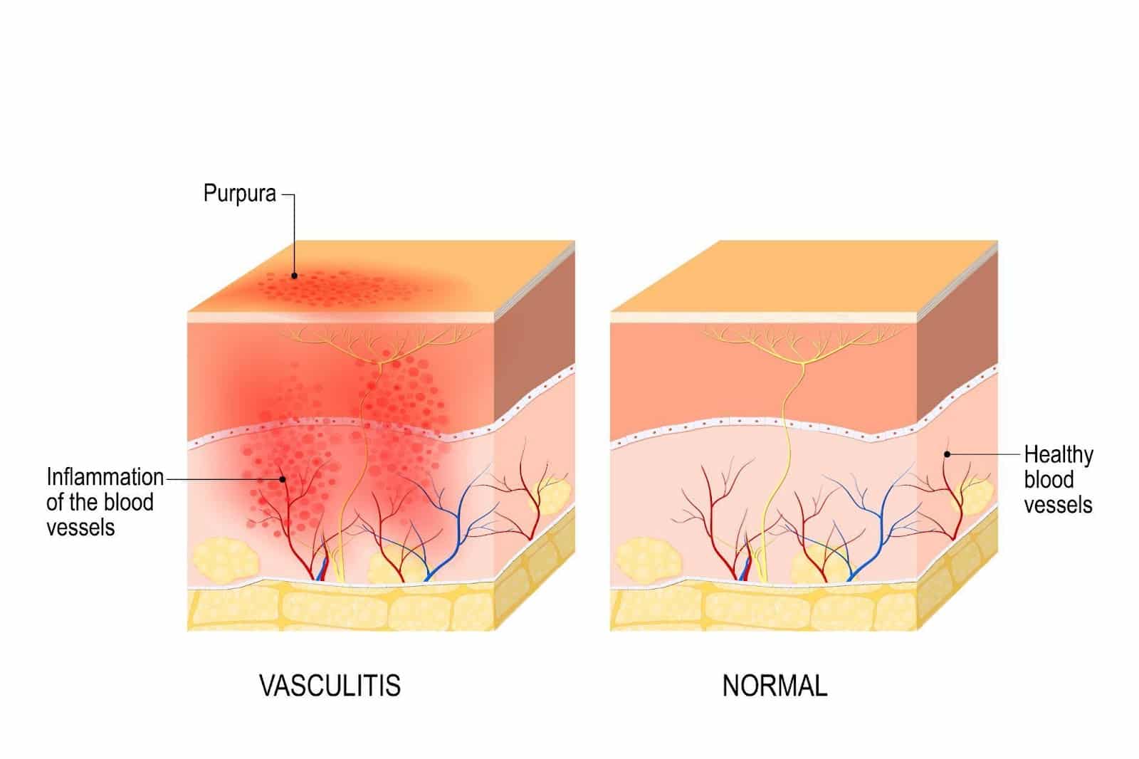 Shedding Light on Vasculitis: Understanding the ‘Invisible’ Battle ...